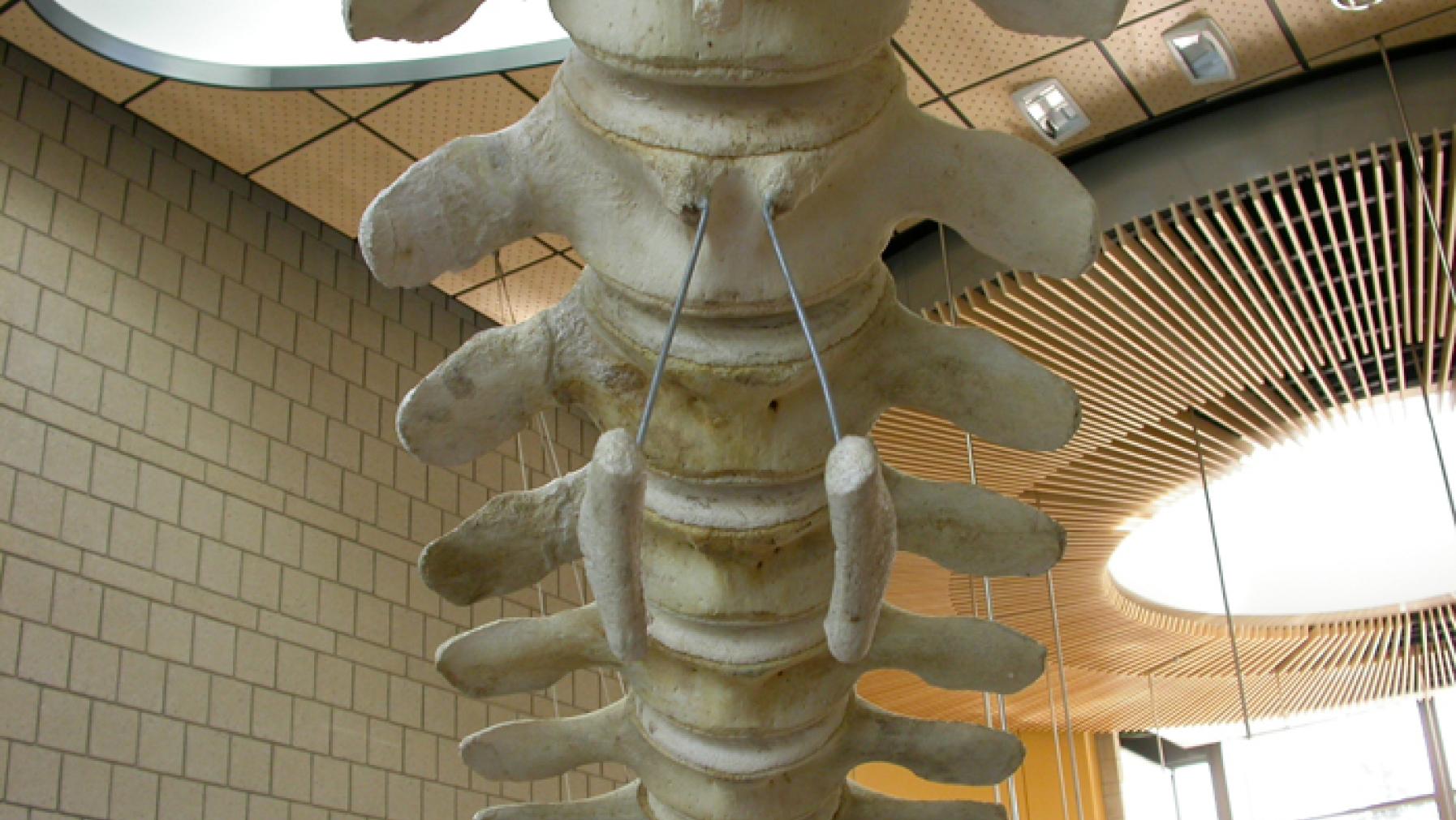 The pelvic girdle remnants held in place with threaded rods.
